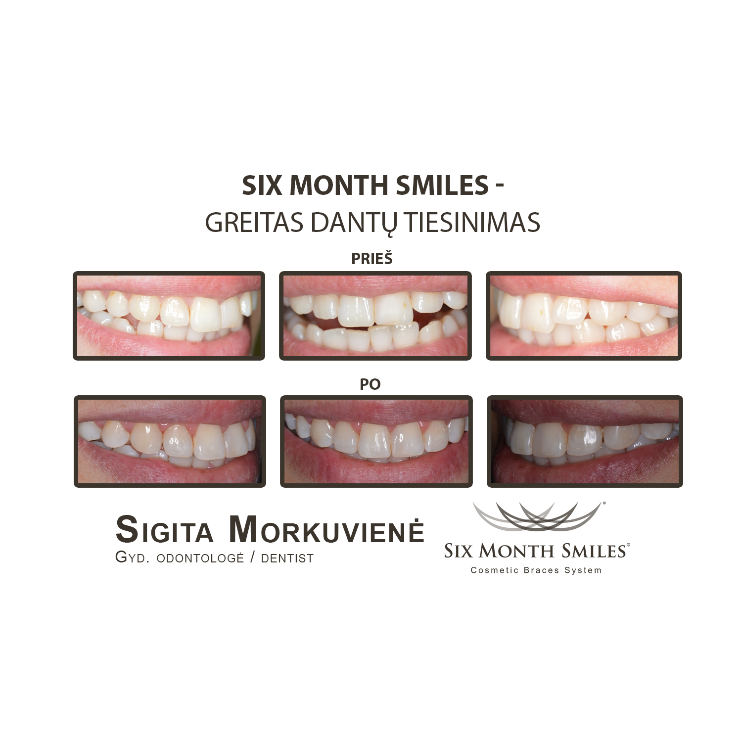 Six Month Smiles